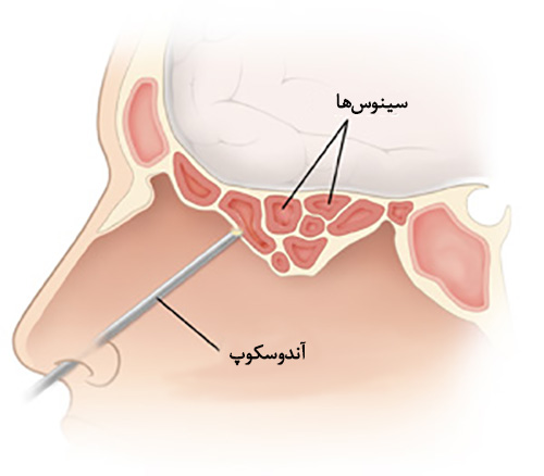 Lateral view of the inflamed ethmoid sinuses with endoscope. SOURCE: pickup from 9B11351