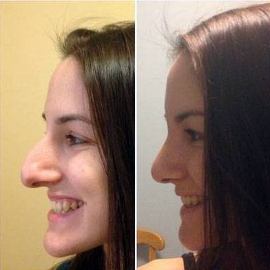 rhinoplasty-big-nose-to-small-nose-before-and-after