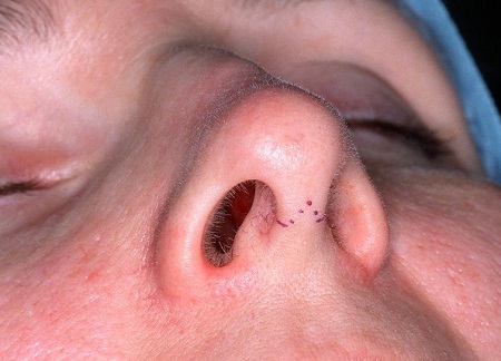جراح برای به حداقل رساندن اثر زخم روی بینی چه کاری انجام می‌دهد؟