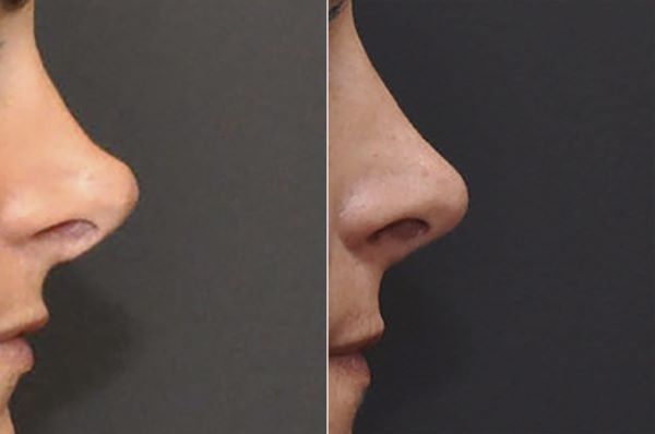 patient 8126 revision rhinoplasty before after 4 1200x796